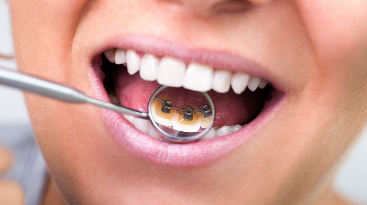 Шесть причин отвести ребенка на консультацию к ортодонту: