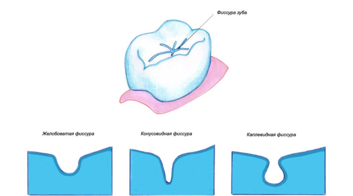 Открытые и закрытые поверхности. Классификация герметизации фиссур.