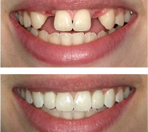 Конические или шиловидные зубы: клиническая картина и особенности