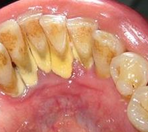 Почему необходимо удаление зубного камня