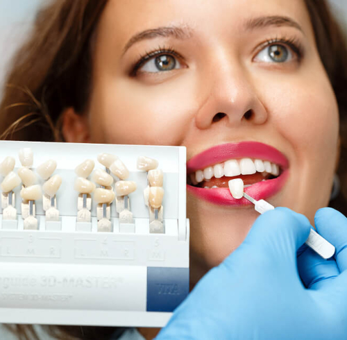 Композитные виниры